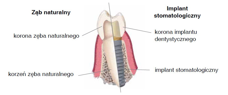 czym jest implant dentystyczny